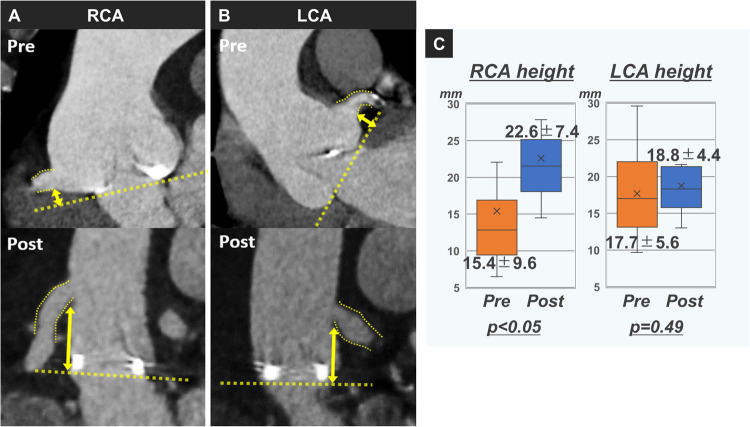 Evaluation of coronary heights after Bio-Bentall using Piehler technique.