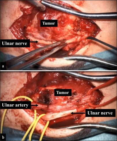 Arteriovenous malformation hemangioma of the ulnar artery: A case report highlighting challenges in diagnosis and surgical management.