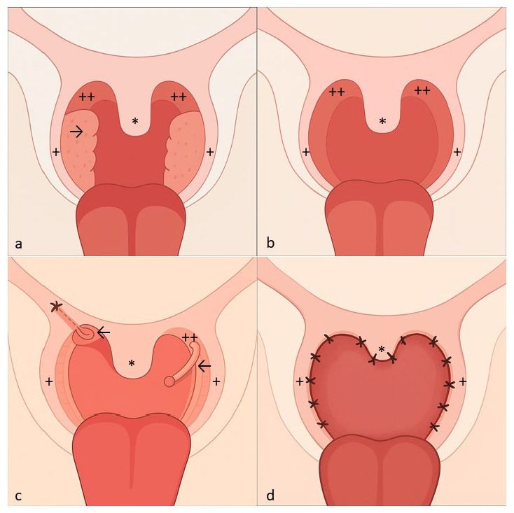 Uvulopalatopharyngoplasty Versus Expansion Sphincter Pharyngoplasty: A Single Centre Experience.