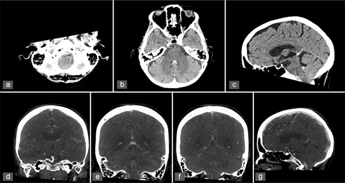 Subarachnoid hemorrhage secondary to Chiari 1 malformation in a patient presenting with recurrent severe headache: A case report, imaging, and anatomic considerations.