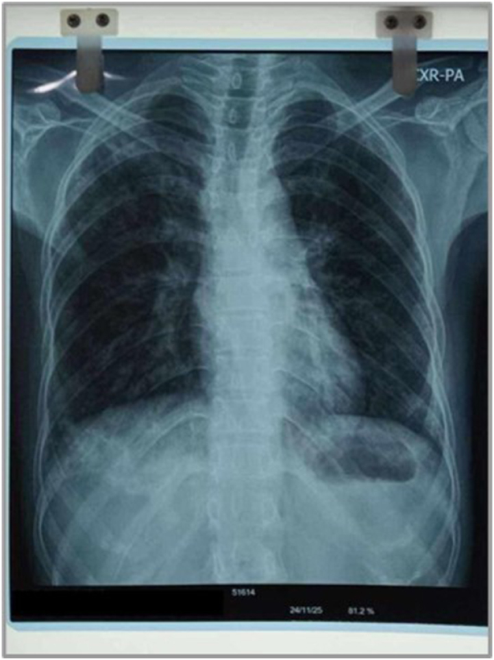 Undifferentiated inflammatory arthritis in a tuberculosis-positive patient: a diagnostic and therapeutic challenge - a case report.