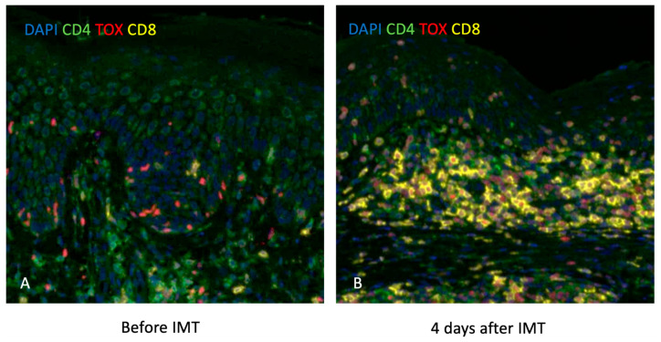 Dermatopathological Challenges in Objectively Characterizing Immunotherapy Response in Mycosis Fungoides.