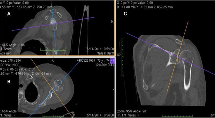 A comparative analysis of manual glenoid version measurement using two-dimensional and three-dimensional computed tomography imaging techniques.