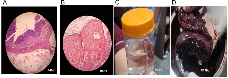 Rare co-occurrence of appendicitis, ovarian dermoid cyst with torsion: a case report.