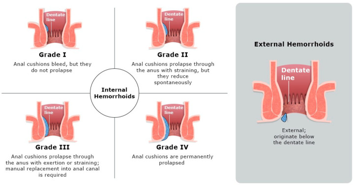 Improving Hemorrhoid Outcomes: A Narrative Review and Best Practices Guide for Pharmacists.