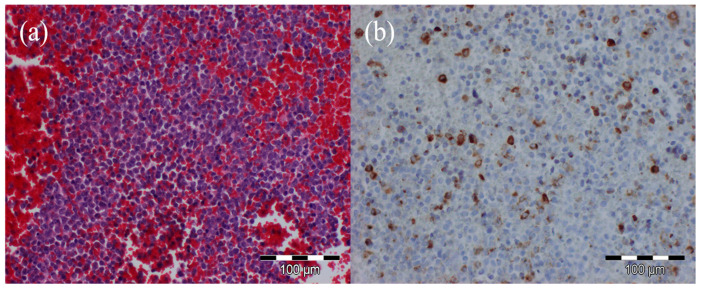 Diagnostic Challenges in Acute Leukemia: From Dental Pain to Catastrophic Intracerebral Hemorrhage.