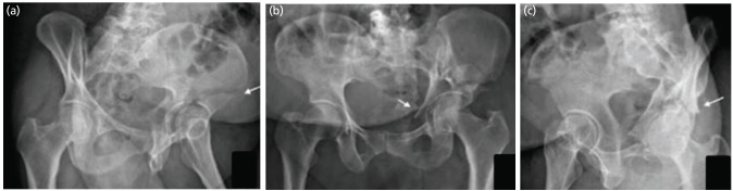 Does the Reliability and Accuracy of the Judet and Letournel Classification System for Acetabular Fractures Increase using a Novel Algorithm?