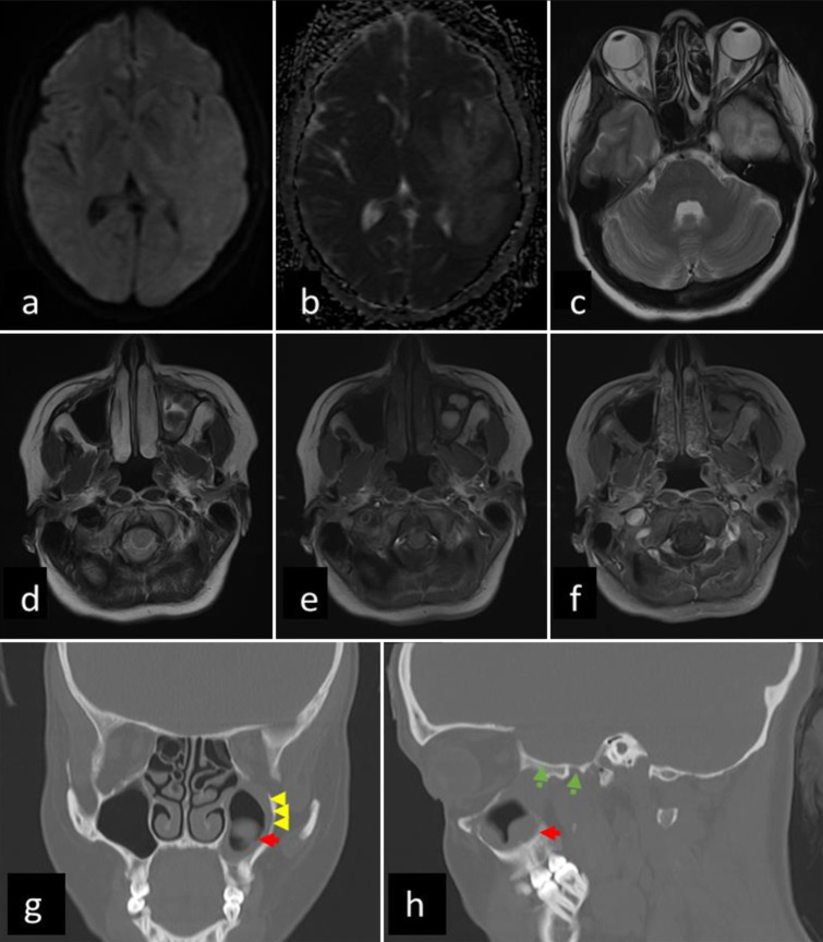 Intracranial fungal mass imitating a high-grade glial lesion - is antifungal alone sufficient?