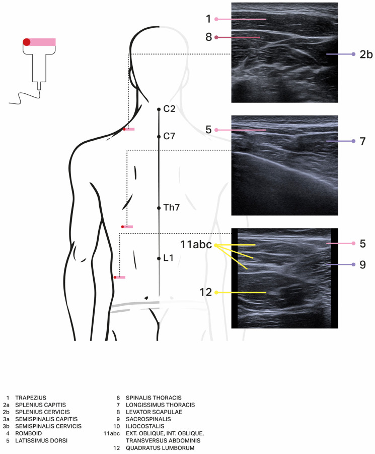 Case Series and Literature Review on Botulinum Toxin Efficacy in Axial Extensor Truncal Dystonia.