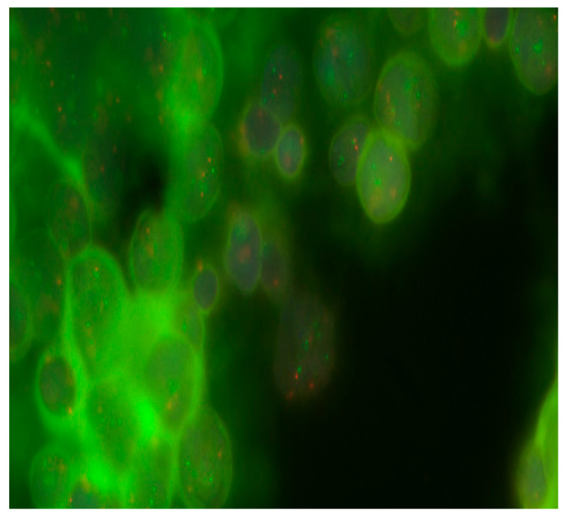 The Prognostic Value of Amplification of the <i>MYCC</i> and <i>MYCN</i> Oncogenes in Russian Patients with Medulloblastoma.