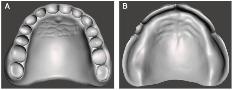 Comparison of the Trueness of Complete Dentures Fabricated Using Liquid Crystal Display 3D Printing According to Build Angle and Natural Light Exposure.