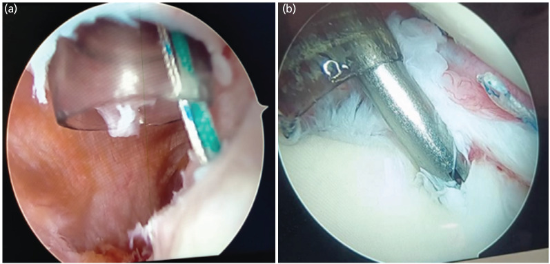 Clinical Outcome of Arthroscopic Bankart Repair and Remplissage in Recurrent Anterior Shoulder Dislocation in Manual Workers.