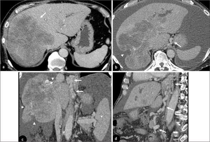 Imaging findings of post-chemotherapy non-metastatic hepatic parenchymal changes.