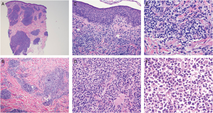 Primary Cutaneous CD4+ Small/Medium-Sized T-Cell Lymphoproliferative Disorder: A Retrospective Cohort Study of 40 Adult Patients.