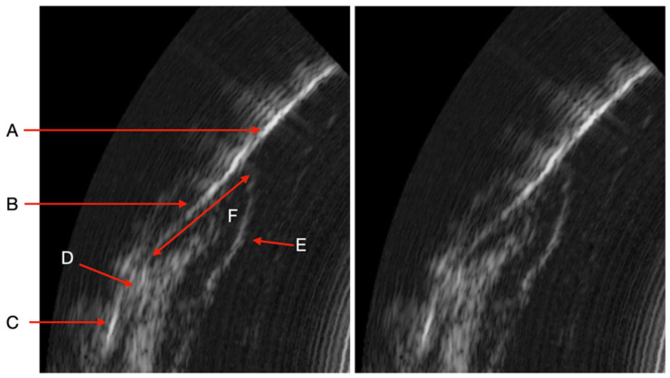 Ultrasound Imaging: Advancing the Diagnosis of Periodontal Disease.
