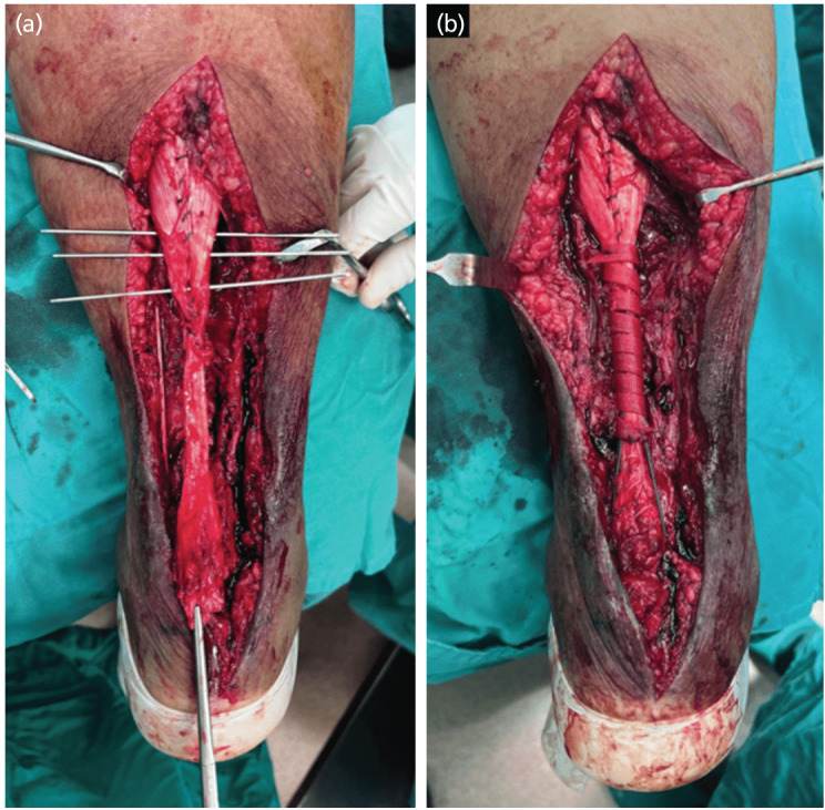 Experience in Managing a Complex Case of Infected Achilles Tendon Rupture with Segmental Loss: A Case Report.