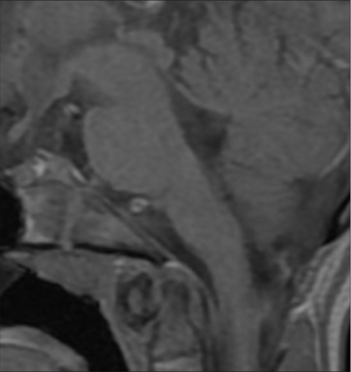 Intrinsic brainstem epidermoid cyst in childhood.