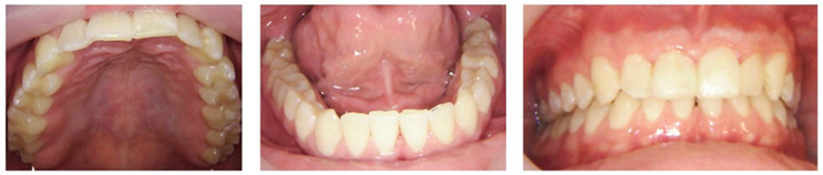A Mixed-Methods Case Report on Oral Health Changes and Patient Perceptions and Experiences Following Treatment at the One Smile Research Program: A 2-Year Follow-Up.