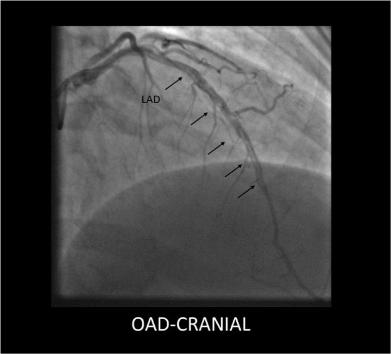 Spontaneous Coronary Artery Dissection Unveiled: Pathophysiology, Imaging, and Evolving Management Strategies.