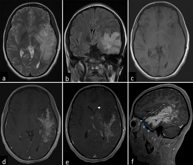 Intracranial fungal mass imitating a high-grade glial lesion - is antifungal alone sufficient?