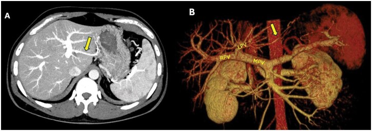 CT imaging of third inflow cases: a hidden cause of surgical complications and liver pseudolesions.