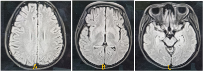 Acquired hemophilia a in a female with minimal change disease and hypothyroidism: a rare case report.