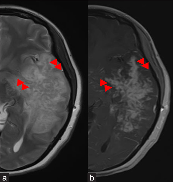 Intracranial fungal mass imitating a high-grade glial lesion - is antifungal alone sufficient?