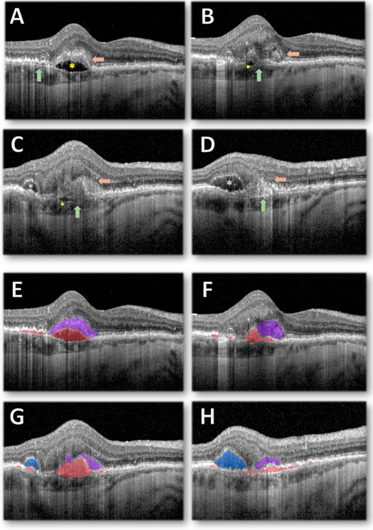 Imaging biomarkers and artificial intelligence for diagnosis, prediction, and therapy of macular fibrosis in age-related macular degeneration: Narrative review and future directions.