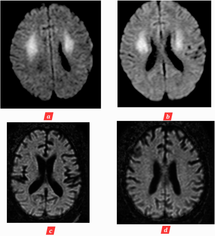 Age inconsistent brain atrophy following post cardiac arrest brain injury (PCABI): case report and review of literature.