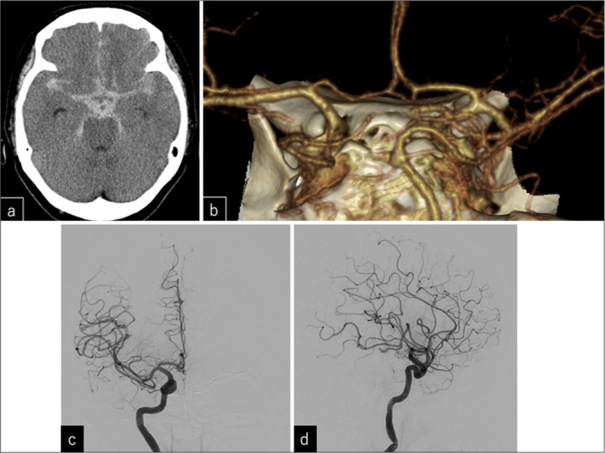 Appearance of an anterior communicating artery aneurysm during vasospasm treatment after angiogram-negative subarachnoid hemorrhage: A case report.