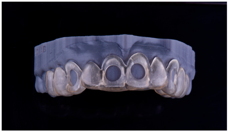 The Use of a Digitally Generated Matrix for Consistent Shade Recording in Tooth Bleaching-A Case Report.