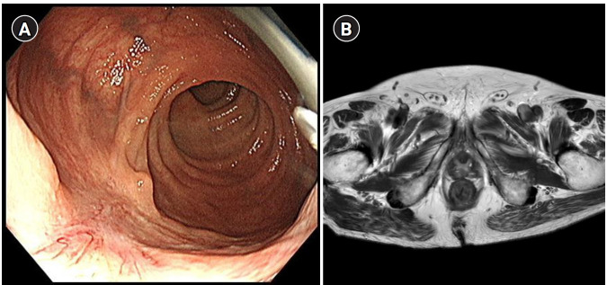 Non-operative management of locally advanced rectal cancer with an emphasis on outcomes and quality of life: a narrative review.