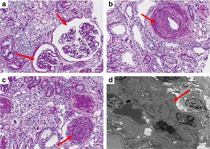 Complement abnormality predisposes to the development of malignant hypertension-associated thrombotic microangiopathy disease.