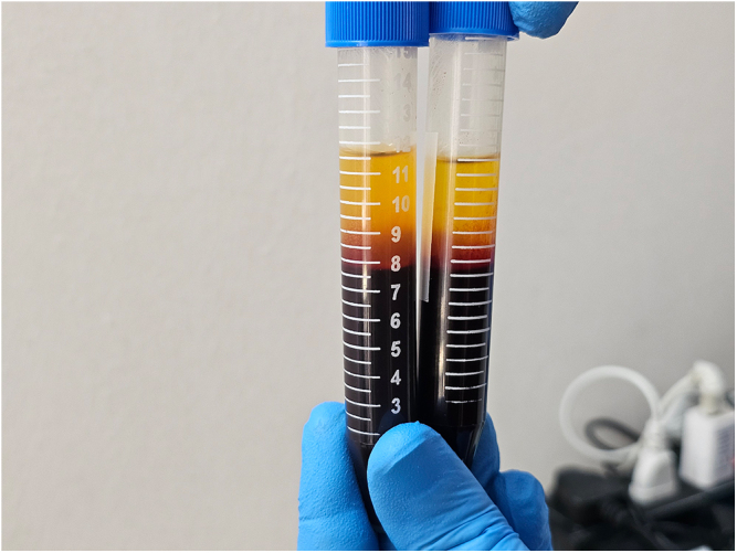 Efficacy of platelet-rich albumin and fibrin gel in two-stage lateral sinus lift: a prospective study.