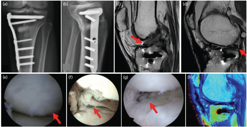 Strategic Integration of Surgical Techniques for Knee Preservation: A Case Report.