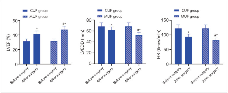 Effects of improved ultrafiltration on serum level of IL-6 and TNF-a, HCT, and cardiopulmonary function in patients with extracorporeal circulation in valve replacement.