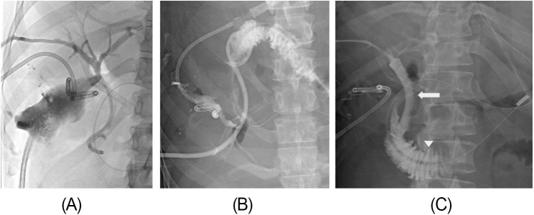 Dual pathology, single solution: concurrent bile duct injury and hepatic artery pseudoaneurysm managed by interventional radiology after converted cholecystectomy.
