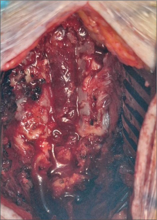 Paraplegia due to epidural T3-T5 hemorrhage of cavernous hemangioma.