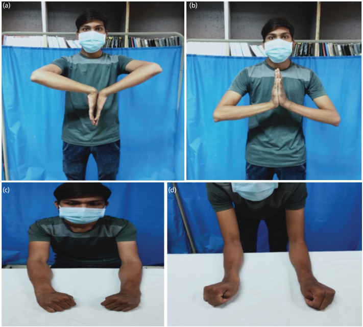 Evaluation of the Functional and Radiological Outcomes of Fixed Angle versus Variable Angle Volar Locking Compression Plates in Managing Intra-articular Fractures of Distal End Radius.
