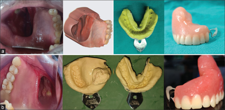 A pilot study comparing conventional and digital impression techniques for speech analysis using Hindi vowels in maxillectomy patients rehabilitated with an obturator.