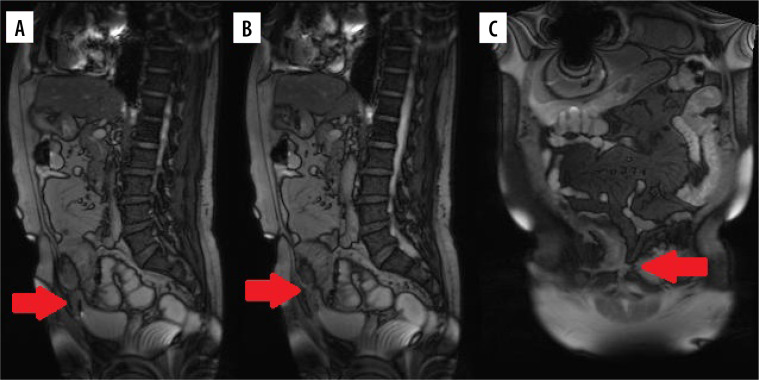 Rare complications of Crohn's disease - a series of three cases.