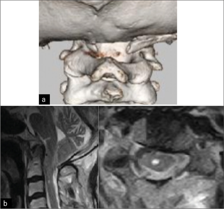 Cough syncope and central sleep apnea caused by CM1 with atlas assimilation in adult: An illustrative case.
