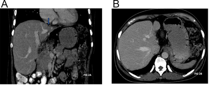 Rare co-occurrence of appendicitis, ovarian dermoid cyst with torsion: a case report.