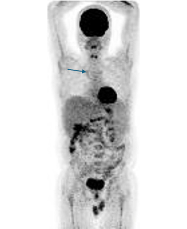 When Less Could be More: Successful Treatment of Granulomatous Lymphocytic Interstitial Lung Disease with Azathioprine.