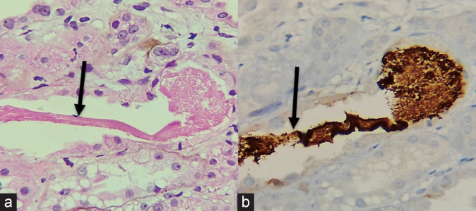 Severe Rhabdomyolysis Due to Presumed Drug Interactions of Dapagliflozin with Rosuvastatin: A Case Report.