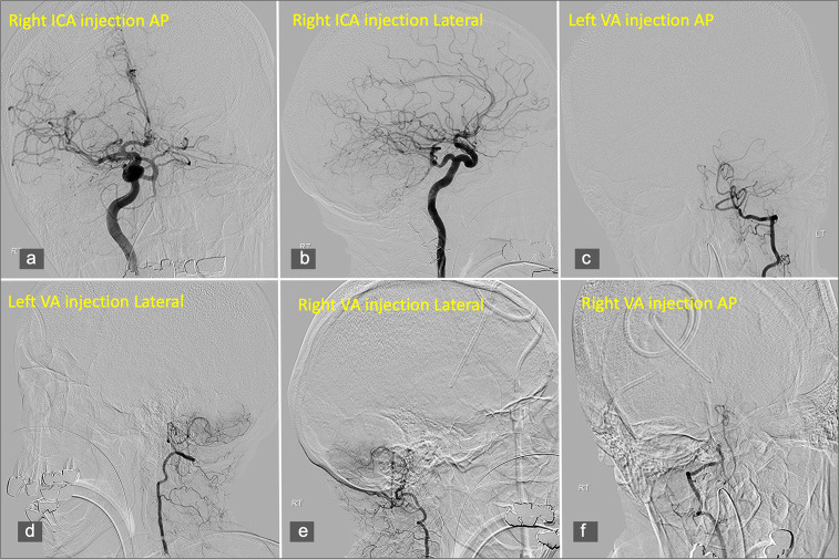 Subarachnoid hemorrhage secondary to Chiari 1 malformation in a patient presenting with recurrent severe headache: A case report, imaging, and anatomic considerations.