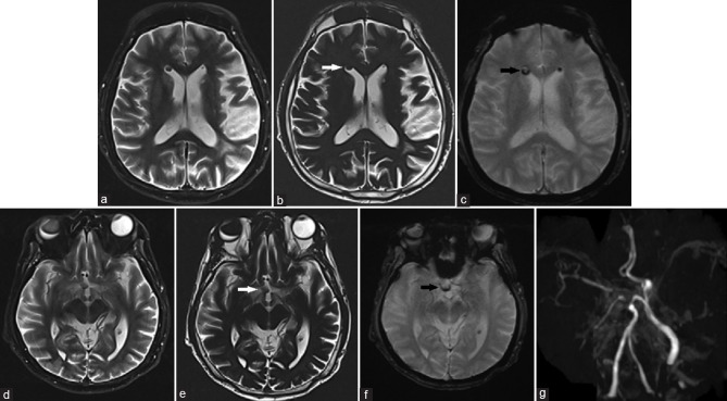 Intraventricular and subarachnoid migration of silicone oil from previous intraocular injection mimicking intracranial haemorrhage: a case report.