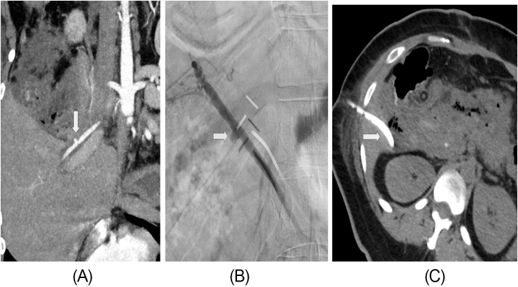 Dual pathology, single solution: concurrent bile duct injury and hepatic artery pseudoaneurysm managed by interventional radiology after converted cholecystectomy.