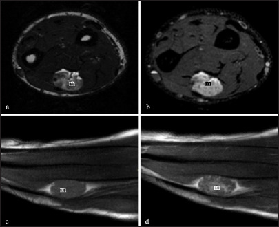 Arteriovenous malformation hemangioma of the ulnar artery: A case report highlighting challenges in diagnosis and surgical management.