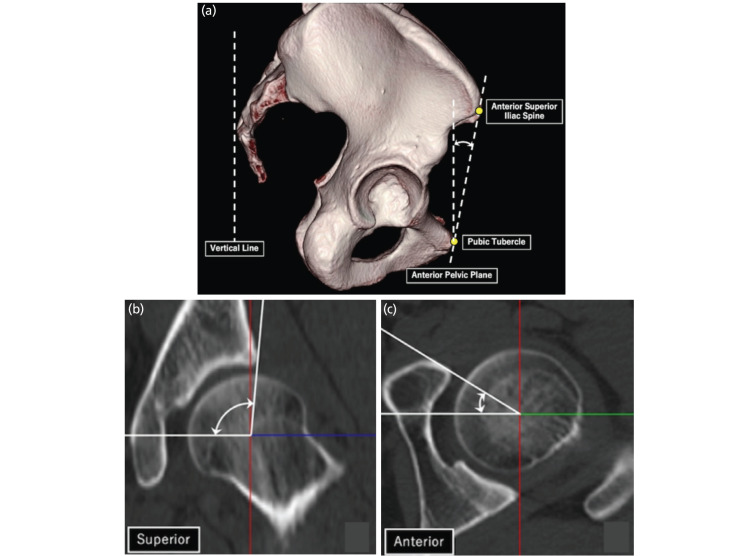 Proximal Femoral Morphology in Development Dysplasia of the Hip Based on Three-Dimensional (3D) Analysis.